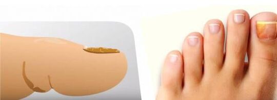 toenail fungus