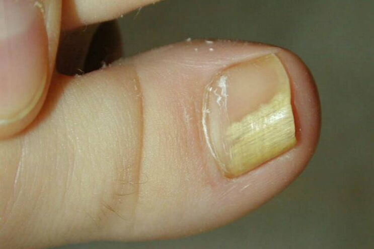 symptoms of toe fungus photo 1