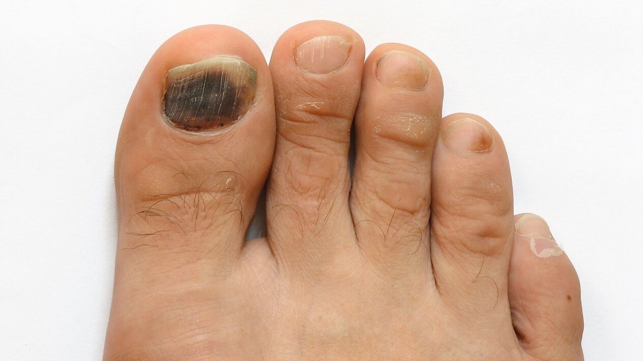 symptoms of toe fungus photo 2