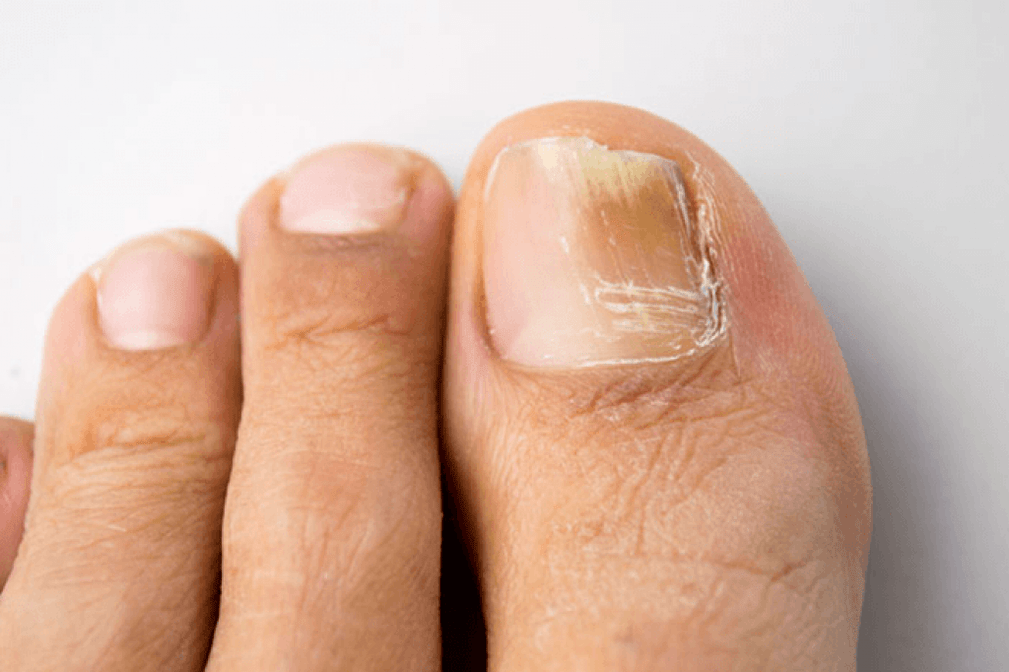 symptoms of toe fungus photo 4