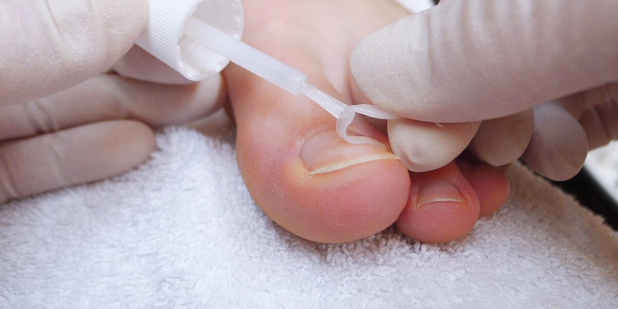 medical varnish against nail fungus