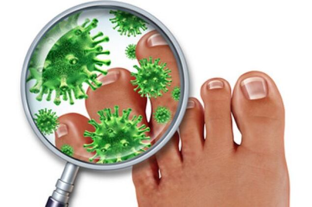 fungal infections of the toenails