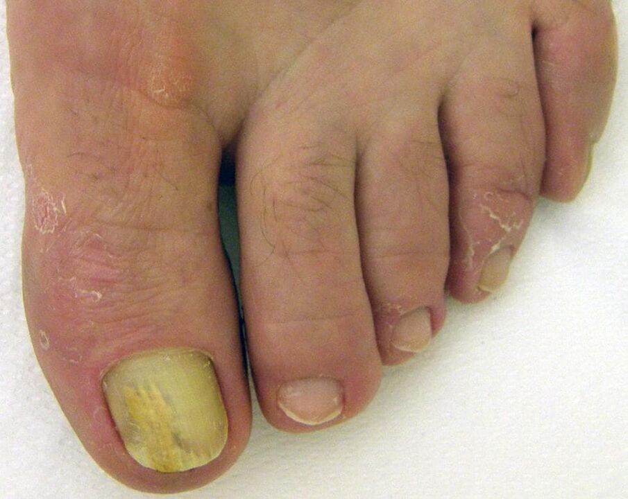 yellow nail with fungus how to treat drops