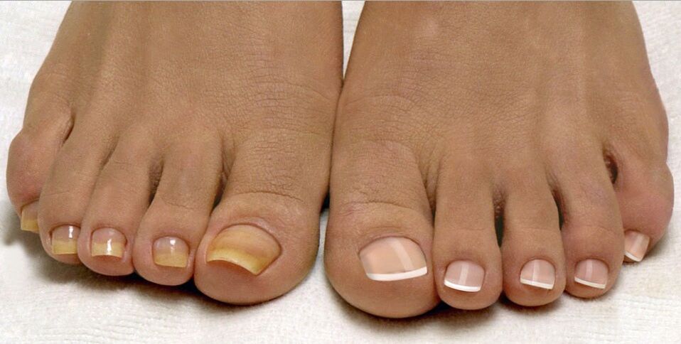 healthy toenails and fungus on the feet