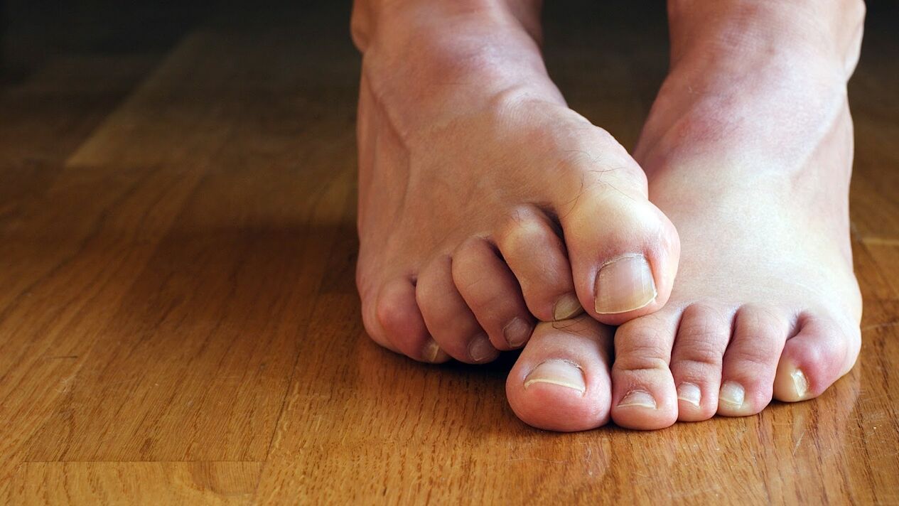 itchy skin of the feet with fungus