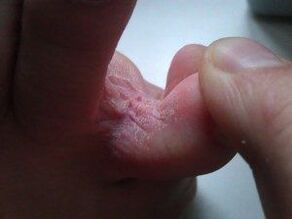 skin lesions between toes with fungus