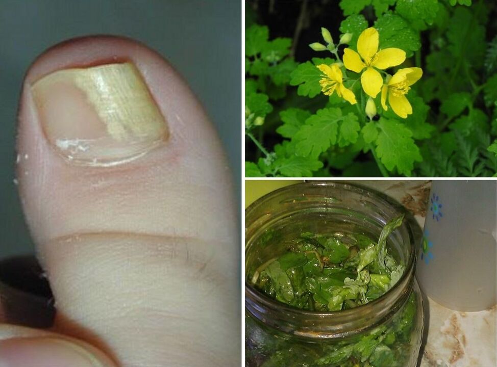 celandine to treat toenail fungus