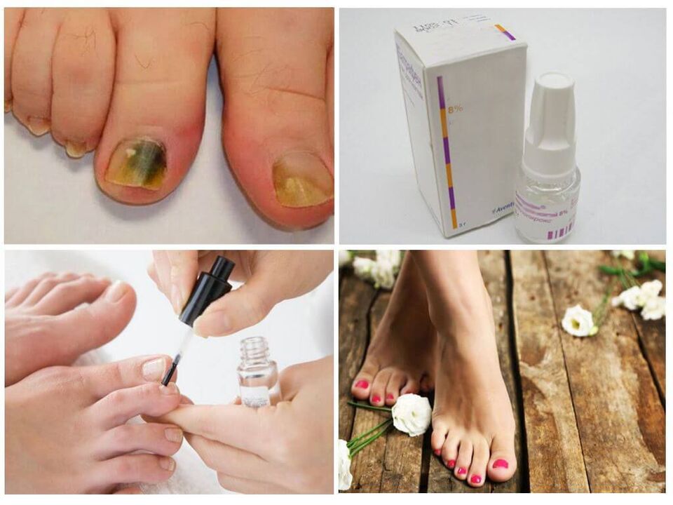 how to use nail polishes against fungus