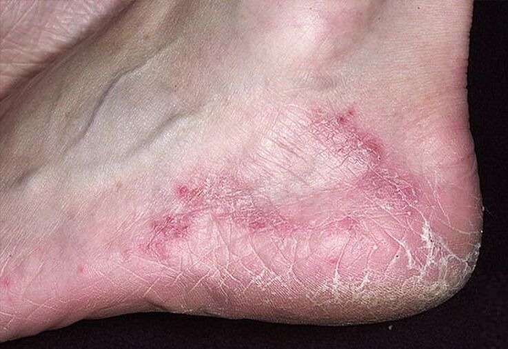 Cracks and redness of the heel skin are signs of a fungal infection