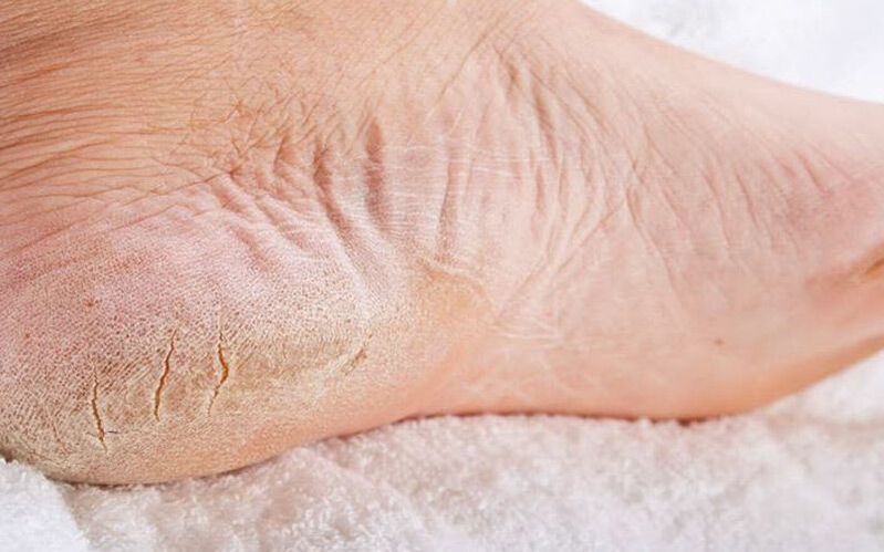 symptoms of foot fungus