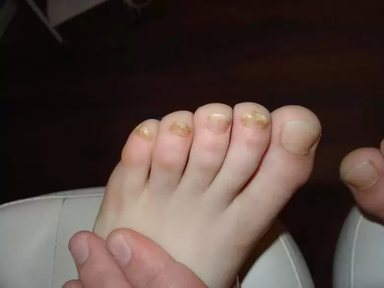 Fungus nail