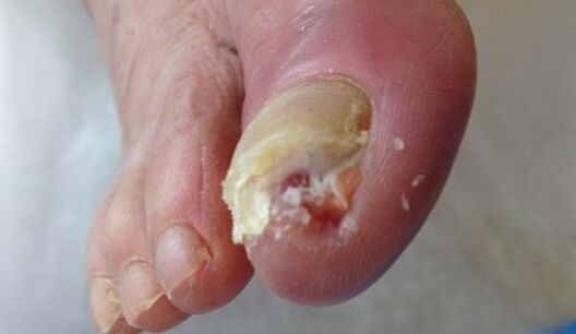 Sick nail