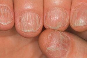 Fungi lesion