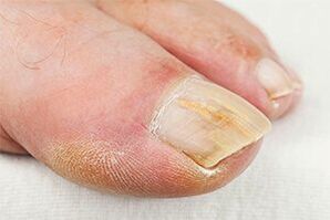 Minced -finger