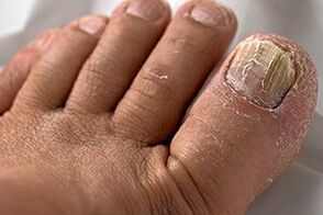 Photo Fungus nail