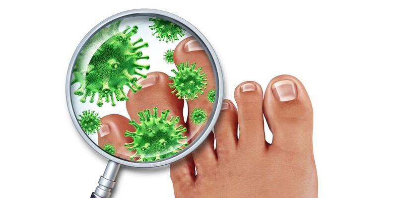 Nails infected with fungi