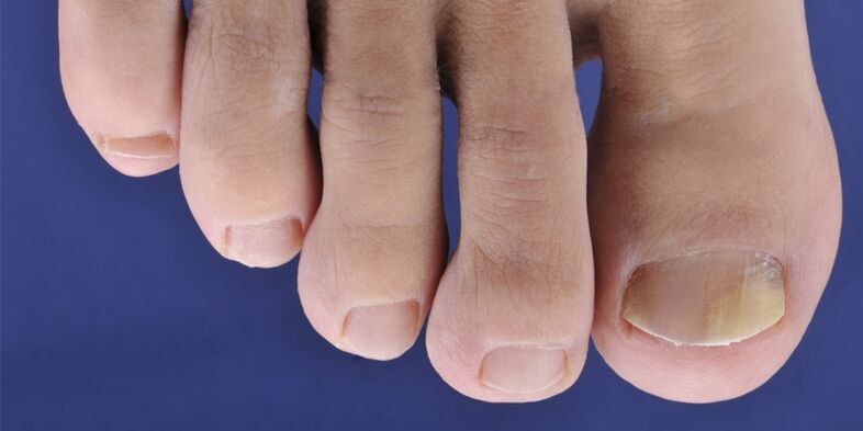 Skin symptoms Mikoze and nail plate