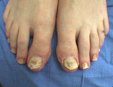 Symptoms Fungi nail