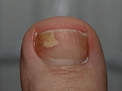 fungus on the left side of the nail