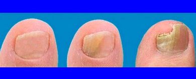 Fungi development phases on toes