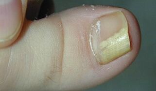 Signs and symptoms of the fungus nail