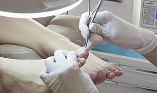 Surgical removal of the nail in the presence of fungi