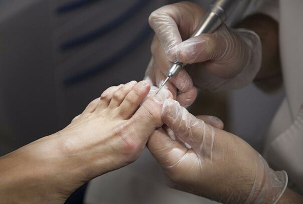 Diagnosis of the Fungus Feet
