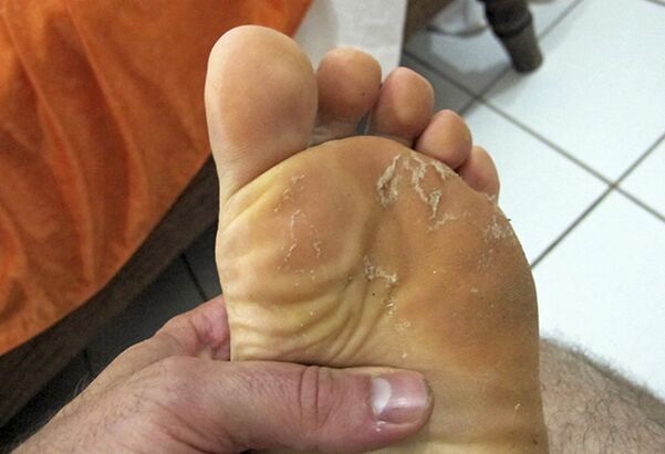 Fungi on the skin of the leg