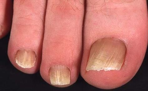 a type of toenail fungus