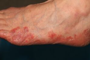 manifestations of foot fungus