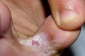 symptoms of fungus between the toes