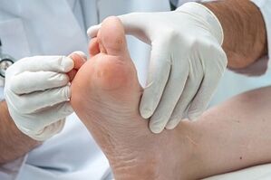 the doctor examines the feet for toe fungus