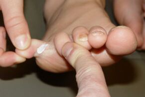 toe fungus