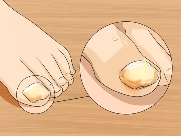 toe fungus