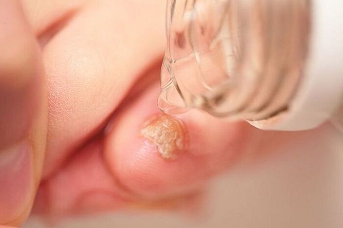 treatment of fungus on the nails of the feet on the nails with vinegar