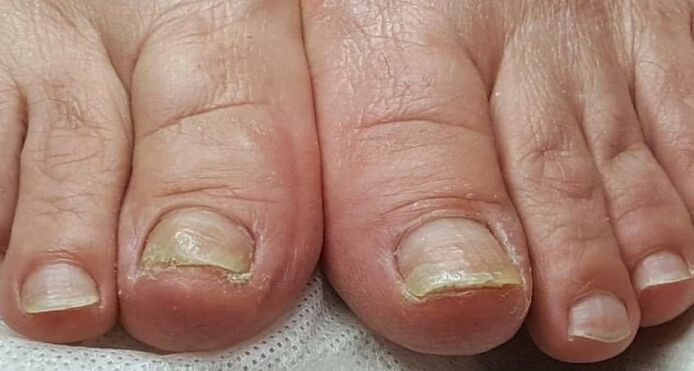 nail fungus damage to the feet