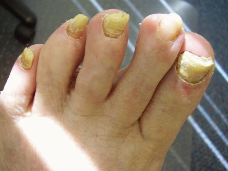 neglected nail fungus on nails