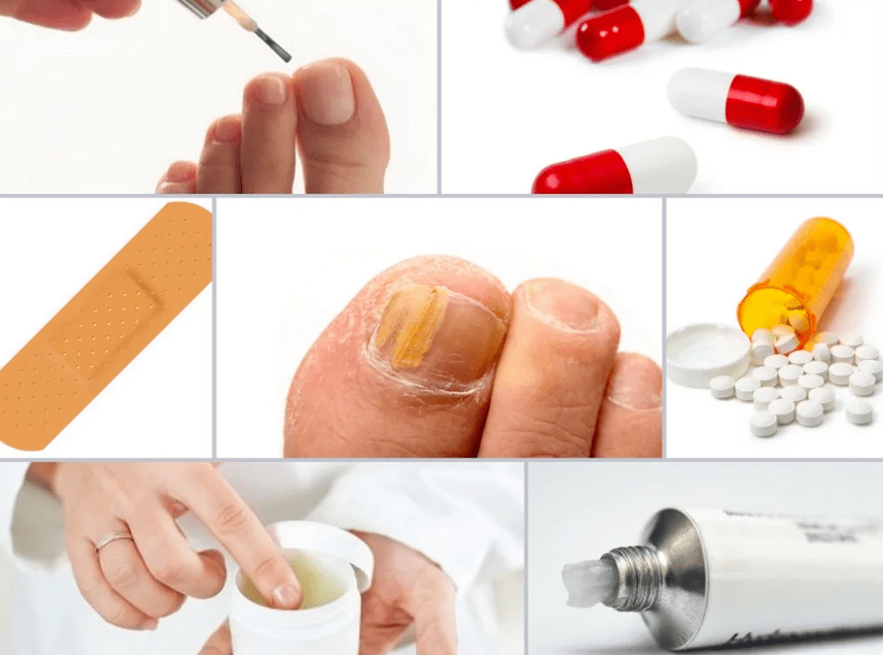 systemic remedies for nail fungus