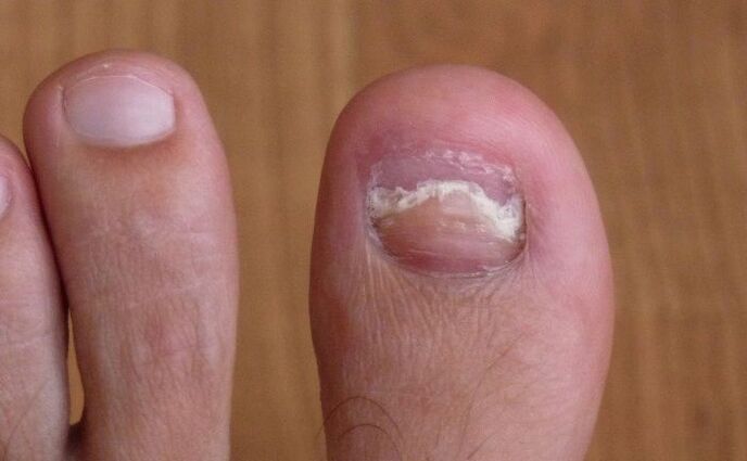 nail damage to the big toe by the fungus