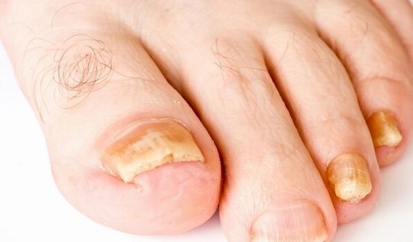 a photograph of the symptoms of toenail fungus