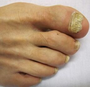 advanced stage fungus on toenails